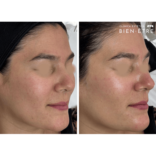 3x Limpieza Facial Embarazadas