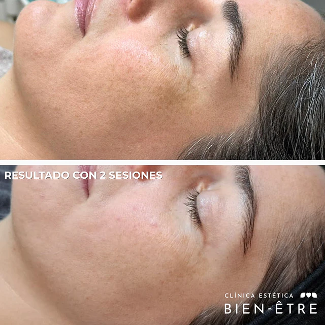 Pigment Therapy (1 sesión)