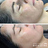Pigment Therapy (4 sesiones + limpieza facial)