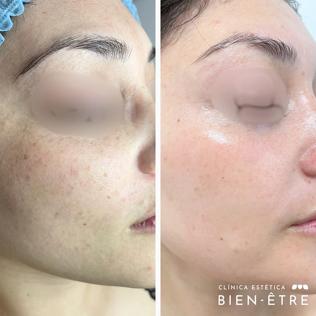 Renovación Total Peeling de Algas