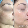 Renovación Total Peeling de Algas