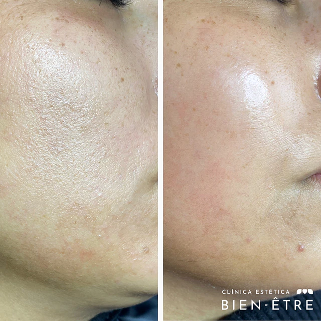 Renovación Total Peeling de Algas