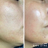 Renovación Total Peeling de Algas