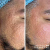 Renovación Total Peeling de Algas