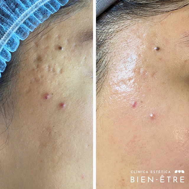 Renovación Total Peeling de Algas