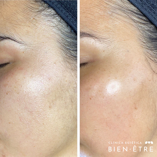 Renovación Total Peeling de Algas