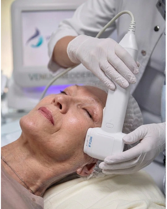 Hifu 12D Full Face - 2 sesiones