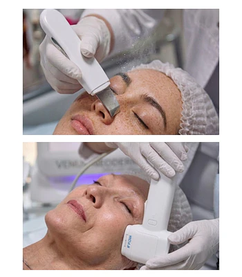 1 Hifu 12D Facial + 1 Limpieza facial profunda