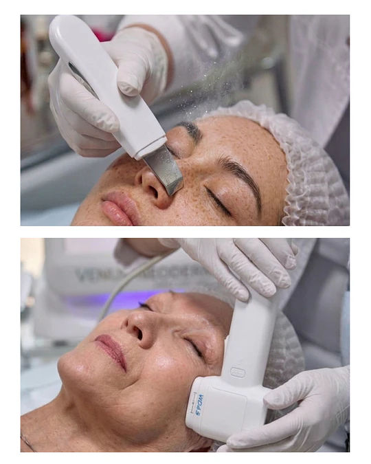 1 Hifu 12D Facial + 1 Limpieza facial profunda