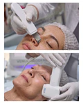 1 Hifu 12D Facial + 1 Limpieza facial profunda