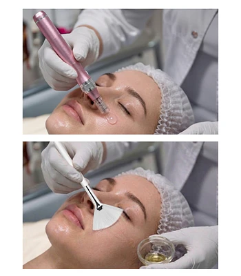 Dermapen Pink Glow + Peeling químico
