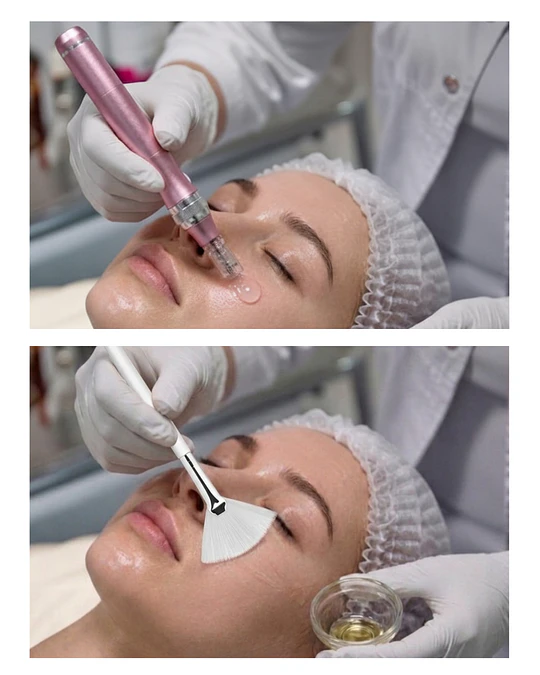 Dermapen Pink Glow + Peeling químico