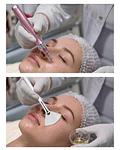 Dermapen Pink Glow + Peeling químico