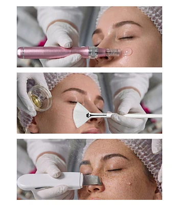 Dermapen Pink Glow + Peeling químico + Limpieza profunda