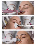 Dermapen Pink Glow + Peeling químico + Limpieza profunda