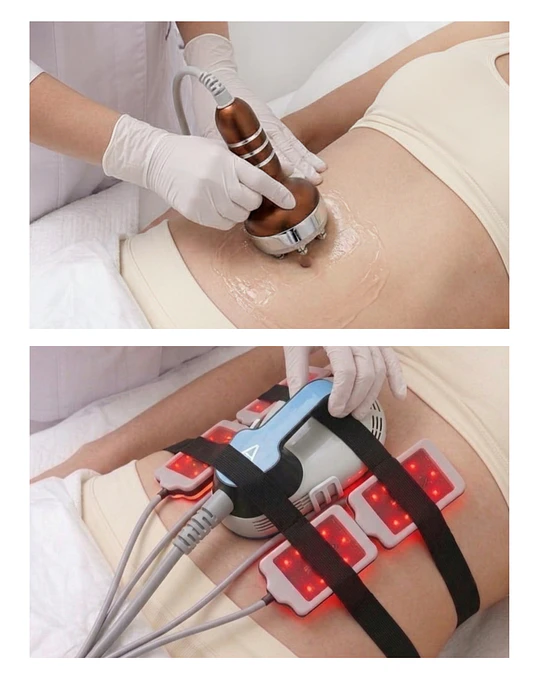 Full Reductivo (Body Sculpt, Cavitación, Radiofrecuencia y Lipoláser)