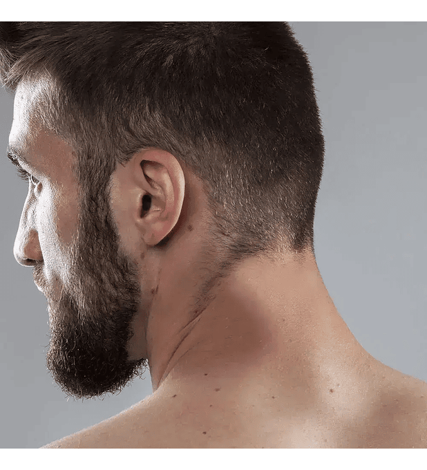 Depilación láser masculina cuello posterior