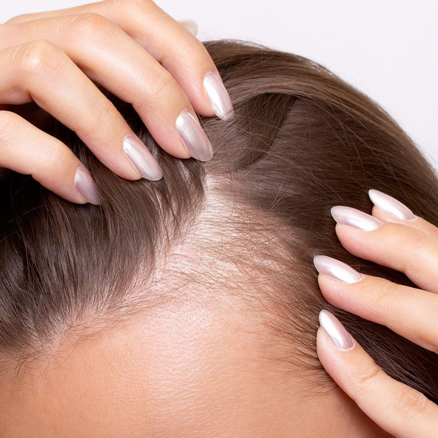 Tratamiento combinado con Mesoterapia Capilar  4