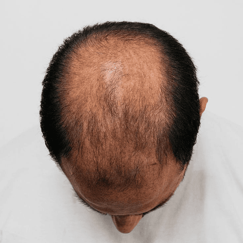 Plasma rico en plaquetas 