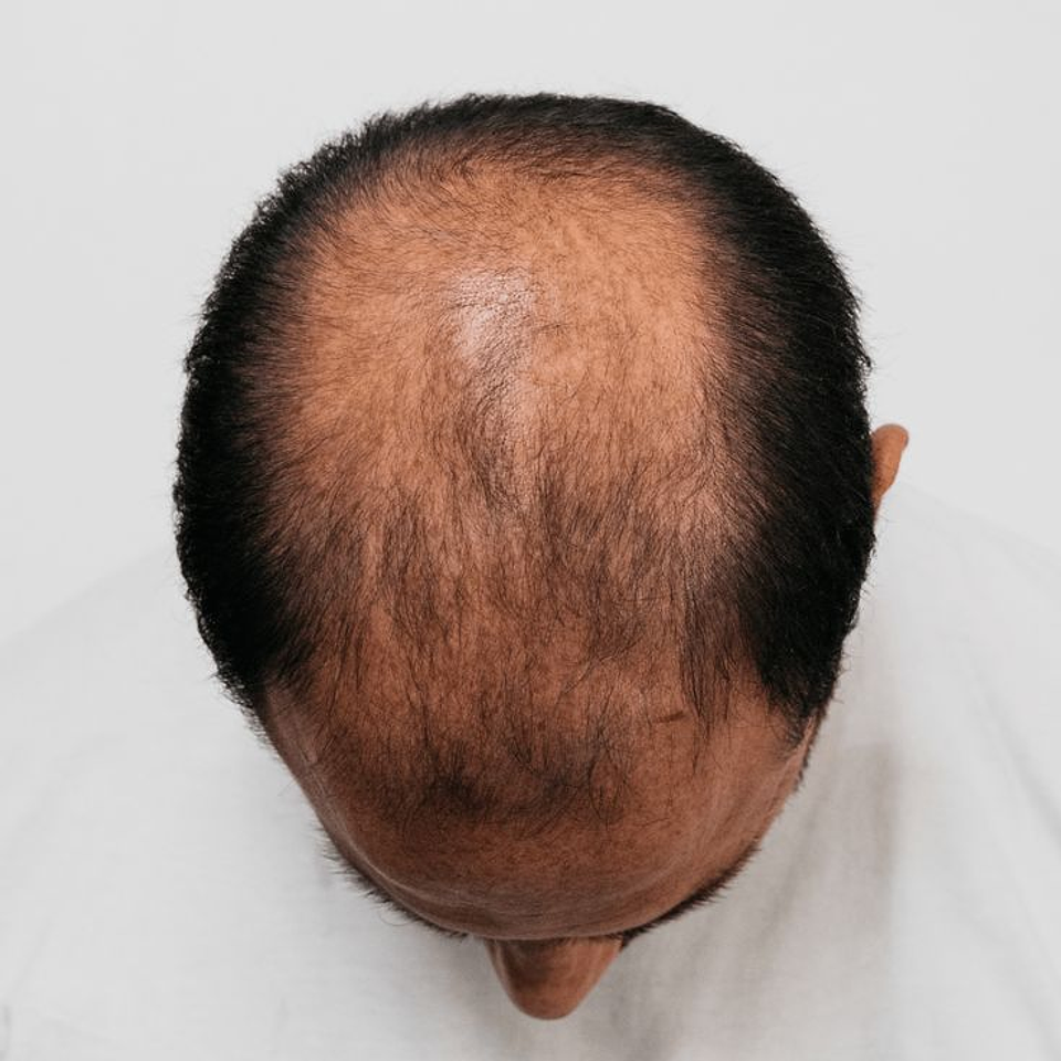 Tratamiento combinado con Mesoterapia Capilar  3