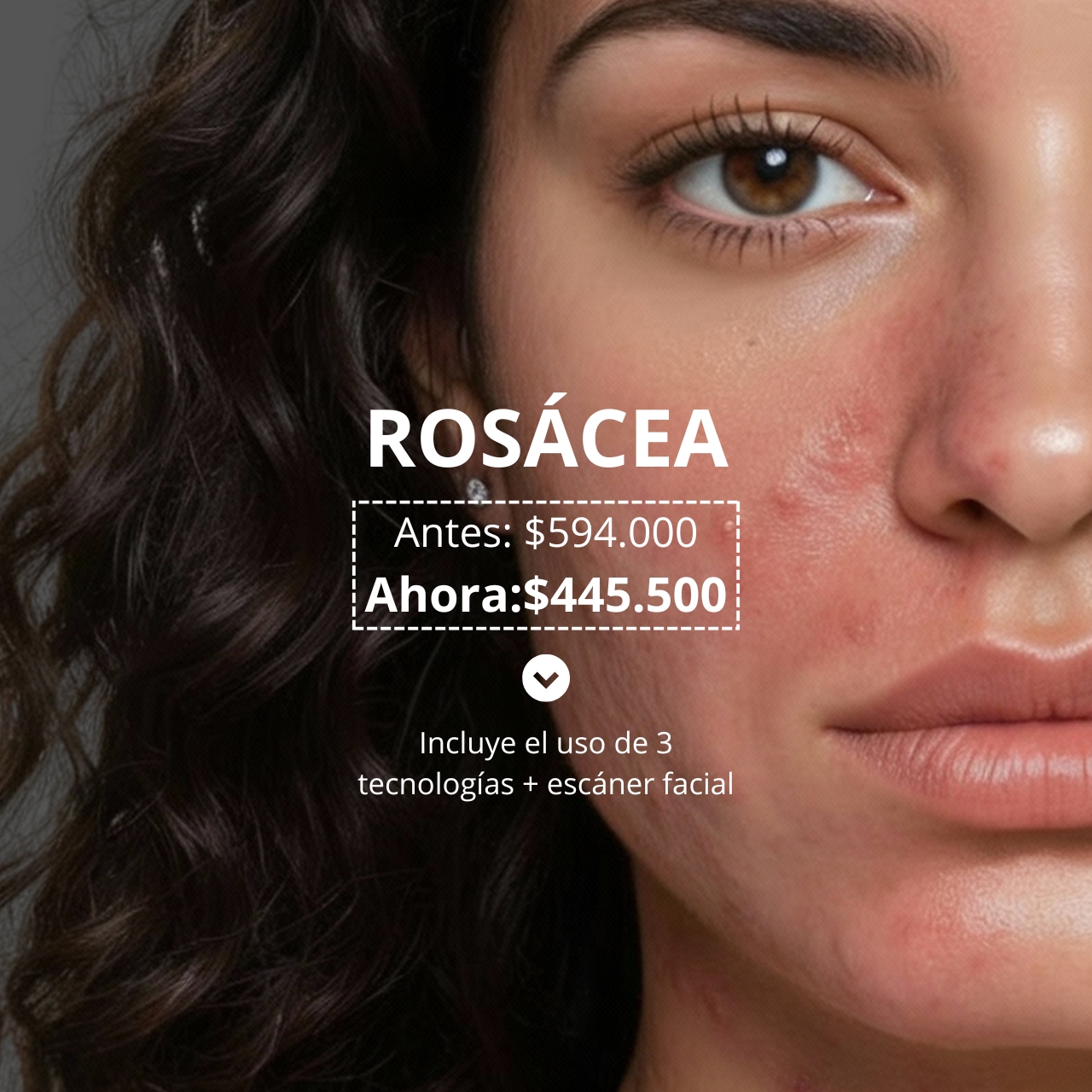 Tratamiento Rosácea