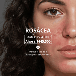 Tratamiento Rosácea