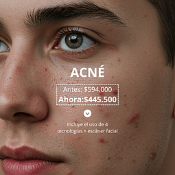 Tratamiento Acné