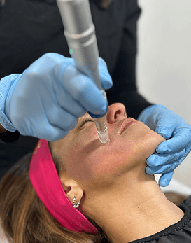 Pack Revitaliza con PRP Premium facial + Mesoterapia con Microneedling