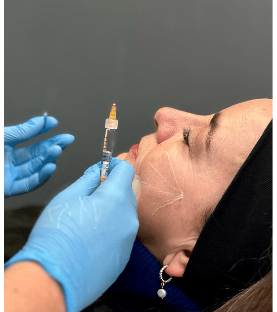 DermicBooster: Pack corrector de arrugas profundas y finas con Reage 3 zonas + Skinboosters (Hasta 2ml)