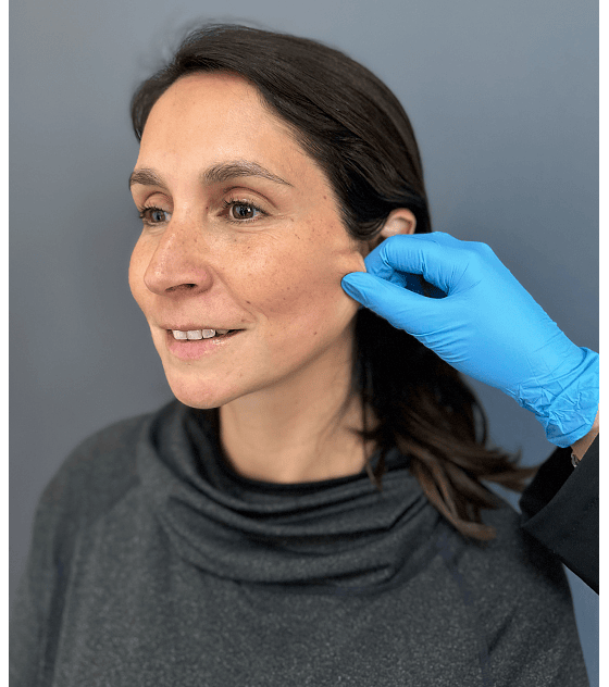 Bioestimulación de Colágeno con Radiesse + Mesoterapia Vitamina C rostro y cuello