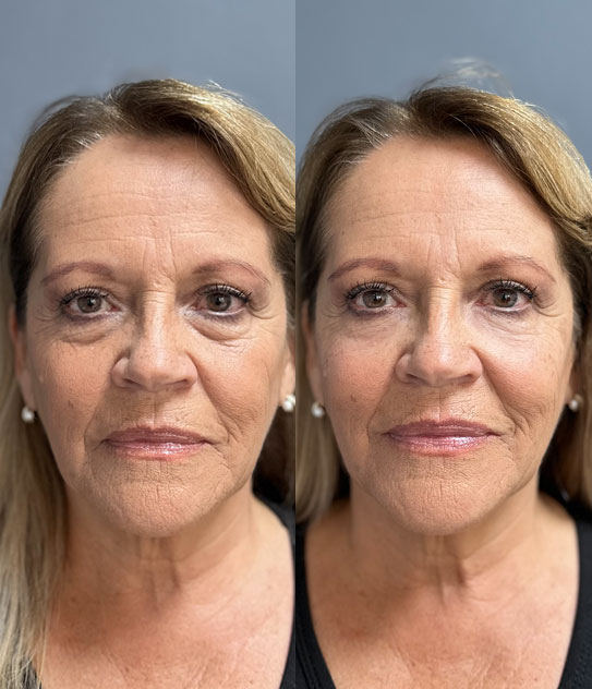 Manchas Mujeres Con RiÃ±ojeras Eliminar Y Corregir Bolsas Y Ojeras