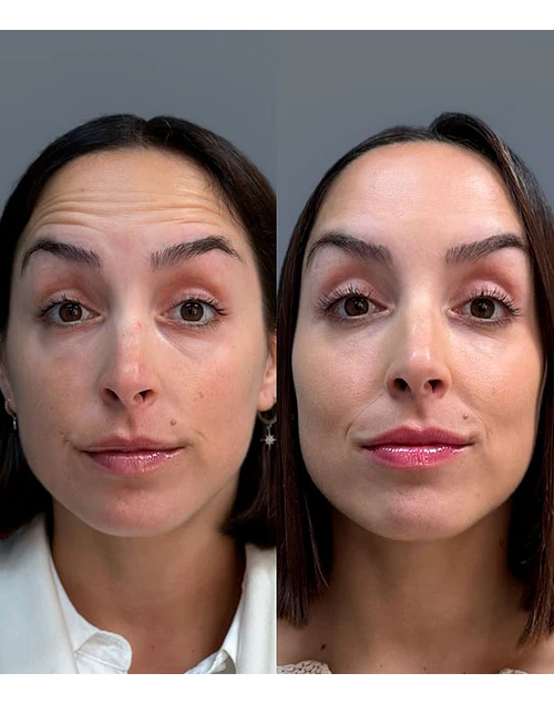 Toxina 3 zonas + Mesoterapia Pink Glow