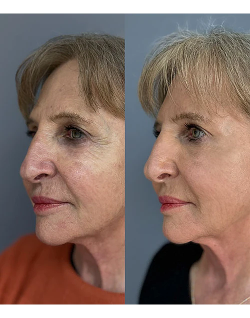 NucleoFill, polinucleótidos de salmón para contorno de ojos, párpados, ojeras