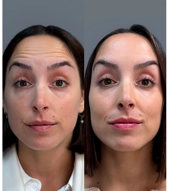 Botox® 3 zonas + 3 Mesoterapias Pink Glow