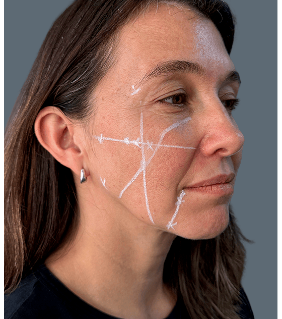 Baby Glow, el despertar de la luminosidad con 3 ml de HA