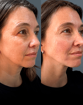 Baby Glow, el despertar de la luminosidad con 3 ml de HA