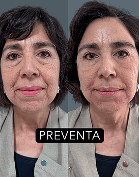 Bioestimulación híbidra para firmeza y volumen Lenisna®