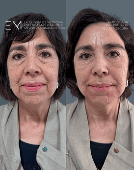 Bioestimulador híbrido para contorno de ojos y calidad de piel Juvelook®