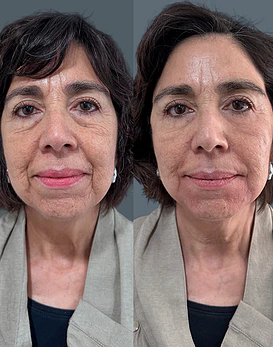 Bioestimulador híbrido para contorno de ojos y calidad de piel Juvelook®