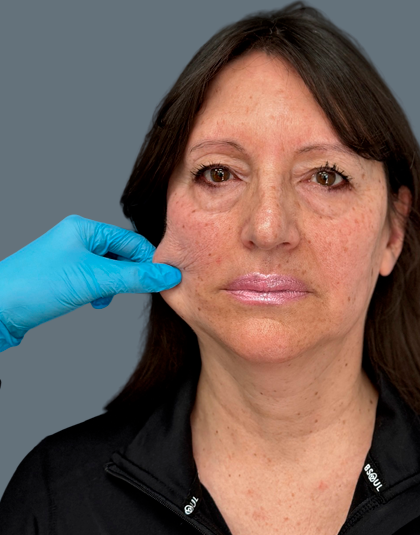https://www.estetikamedica.cl/cyber-cuello-arrugas-por-que-los-bioestimuladores-son-la-solucion