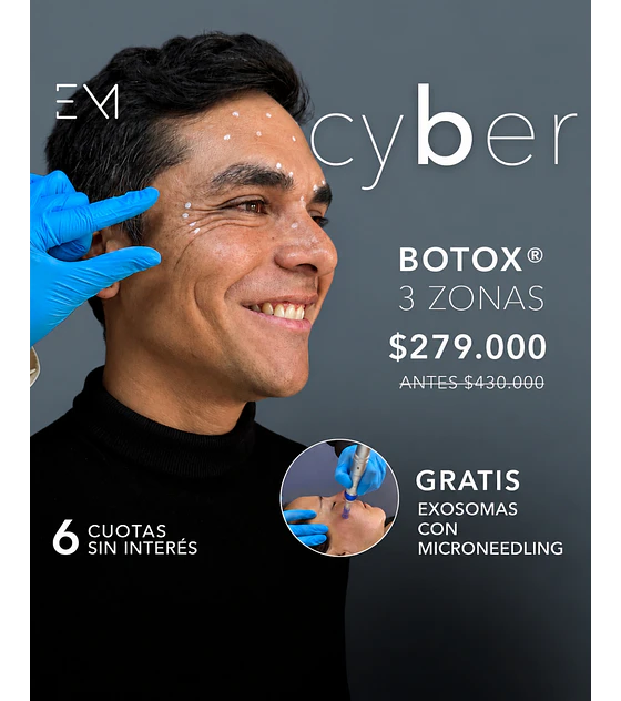 Toxina 3 zonas + Microneedling +exosoma