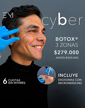 Toxina 3 zonas + Microneedling +exosoma