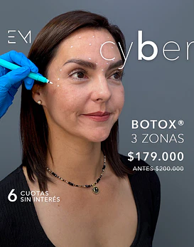 Toxina Botulínica para eliminar arrugas