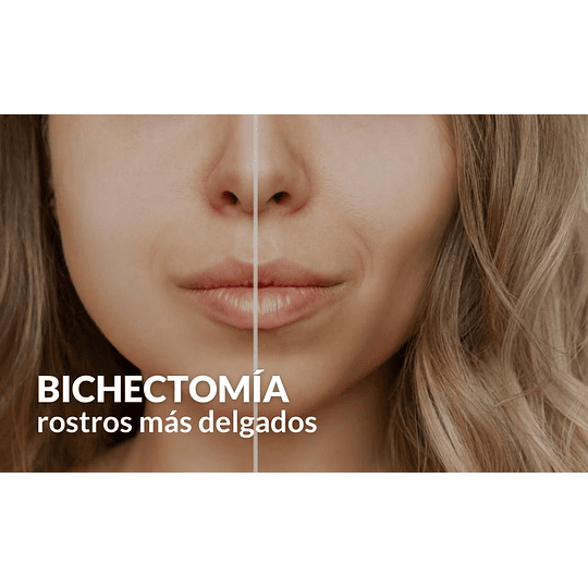 Bichectomía - Image 1