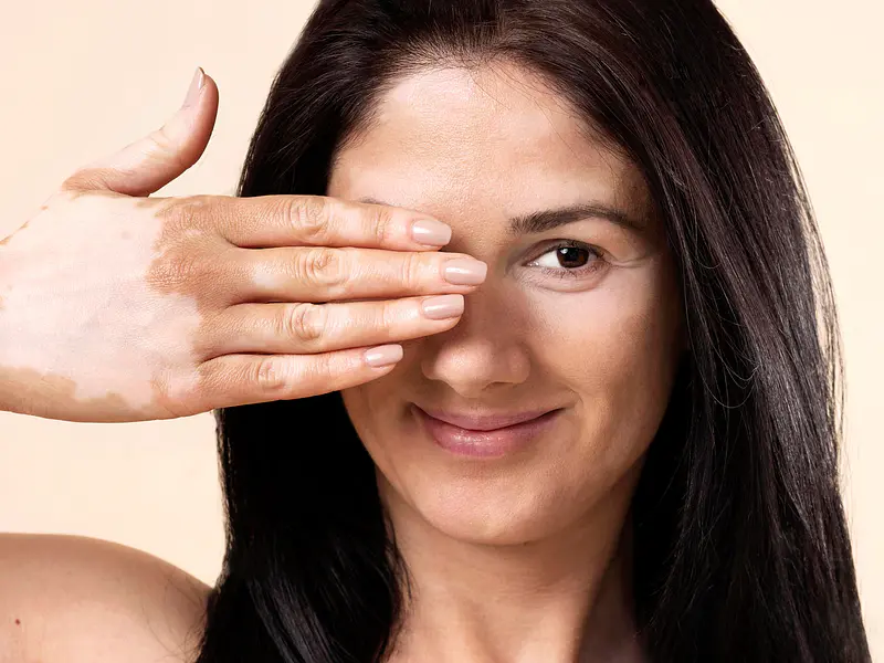 Melasma, Manchas de Sol y Lentigos Solares