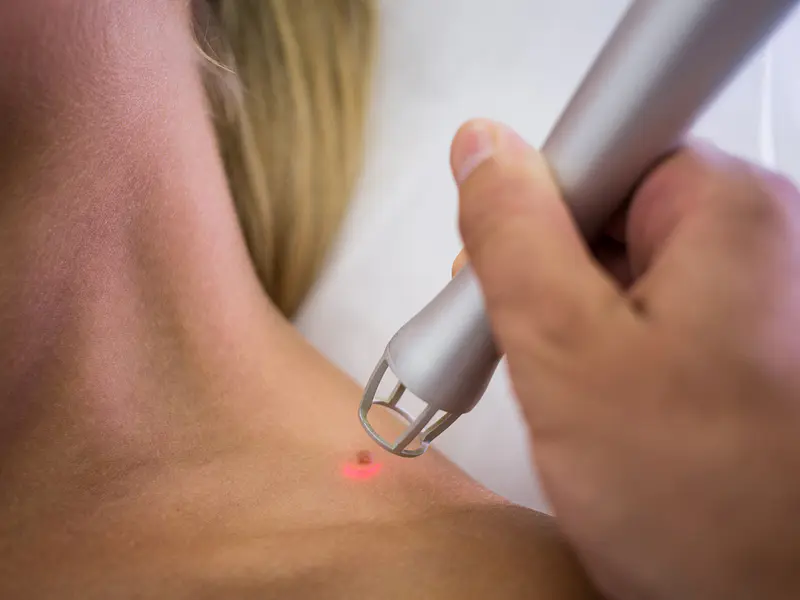 NY Eliminación de Tatuajes