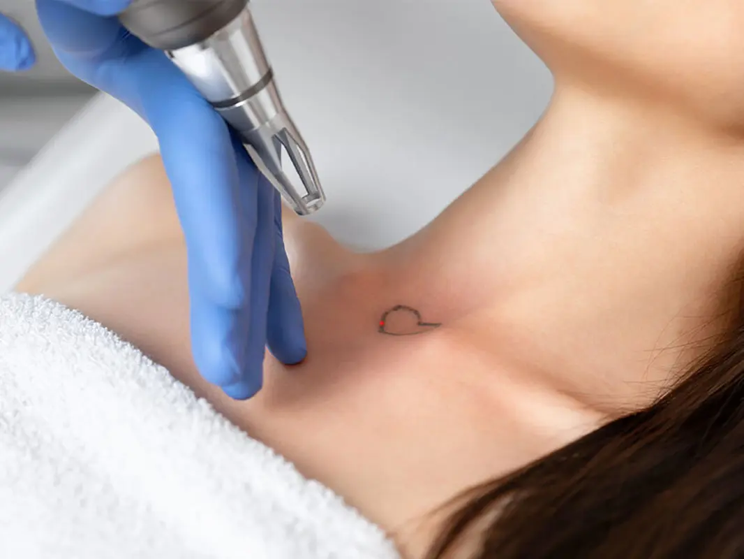 Eliminación de Tatuajes