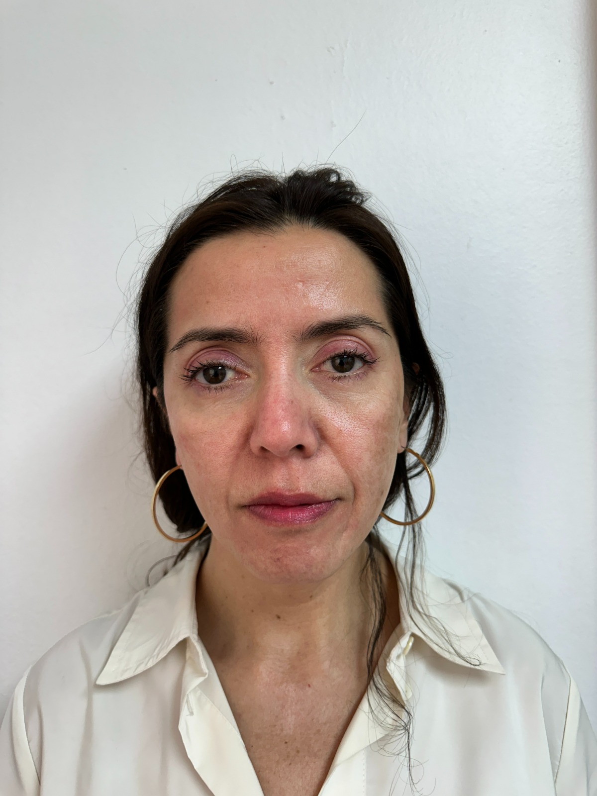 Antes bioestimuladores