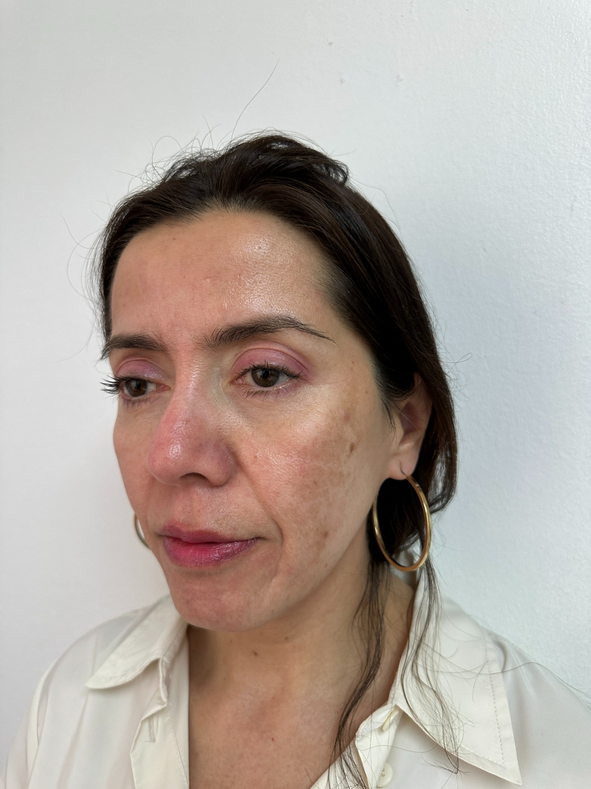 Antes bioestimuladores