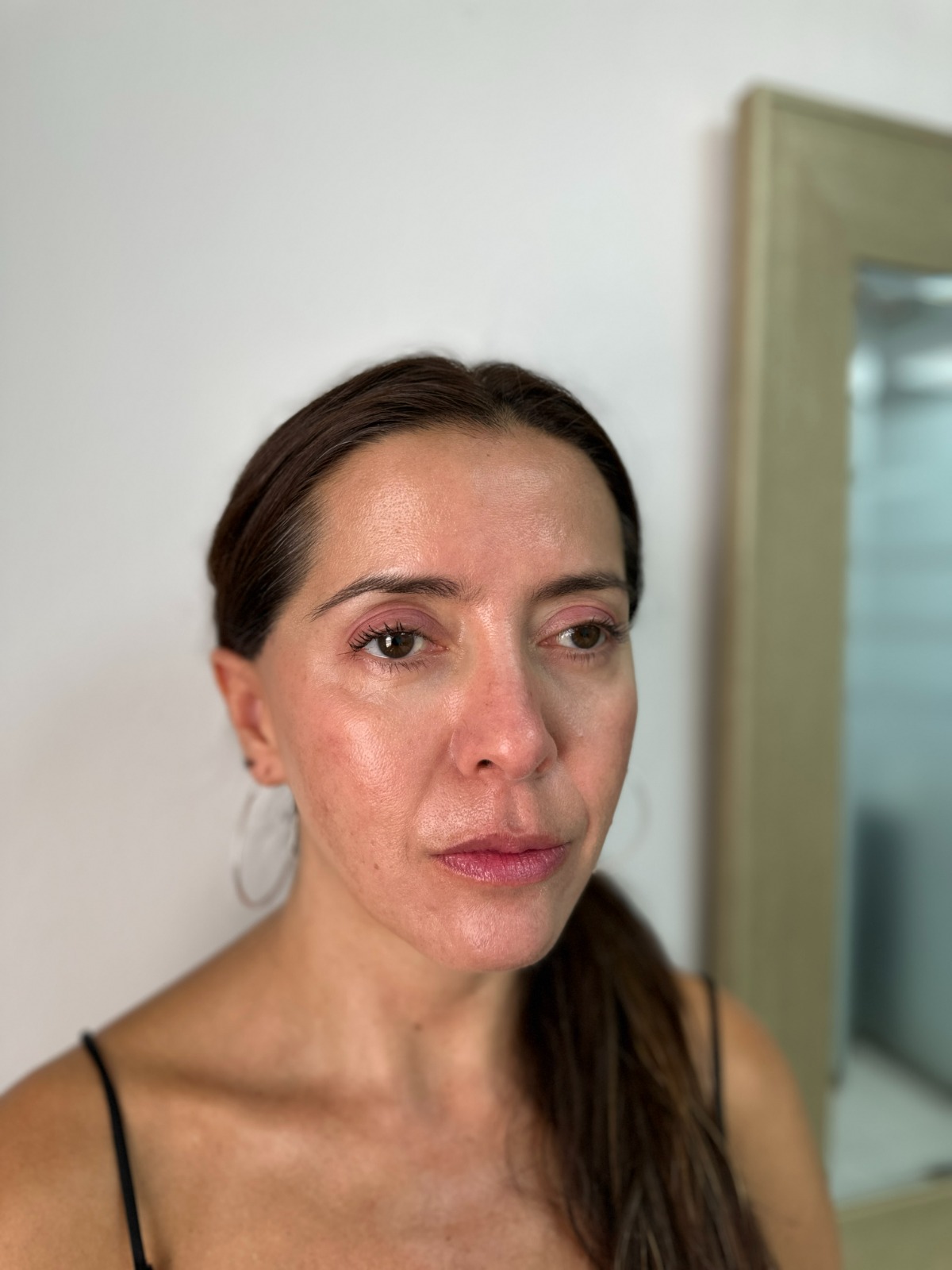 Después bioestimuladores